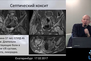 Цориев А.Э. Поражения костной-суставной системы при СПИДе