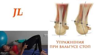 Упражнения при вальгусе стоп.