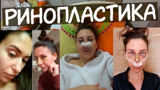 СДЕЛАЛА РИНОПЛАСТИКУ  НОВЫЙ НОС / Сколько стоит ринопластика  Как Я РЕШИЛАСЬ / риносептопластика